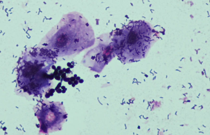 Prélévement vaginal avec perte de la population lactobacillaire, présence de petits bacilles Gram positif (Gardnarella vaginalis) et quelques cocci Gram positif en amas (parfois en tétrade) type staphylococcus et présence de levures.