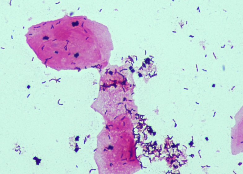 Prélévement vaginal avec perte de la population lactobacillaire, présence de petits bacilles Gram positif (Gardnarella vaginalis) et quelques cocci Gram positif en amas (parfois en tétrade) type staphylococcus.